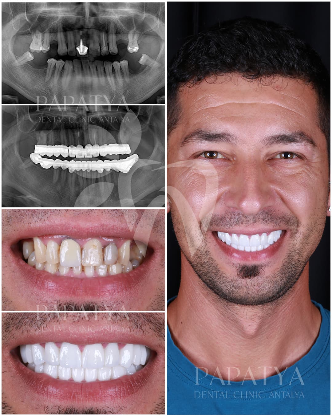Hollywood Smile before and after result
