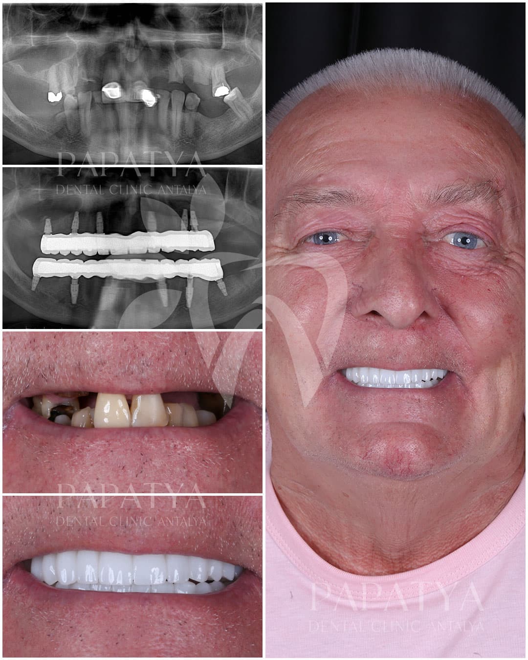 All-on-6 Implant before and after result
