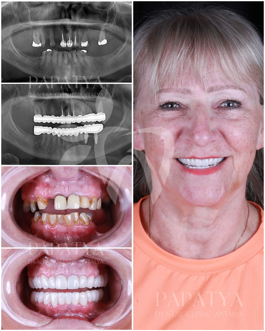 Dental Implant before and after result