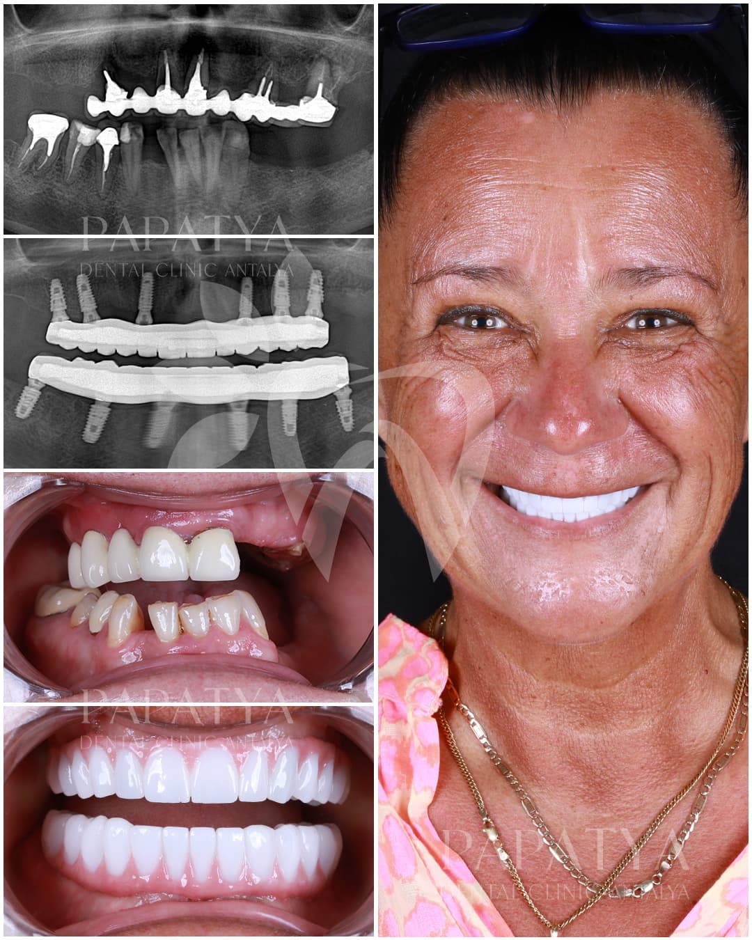 All-on-6 Implant before and after result
