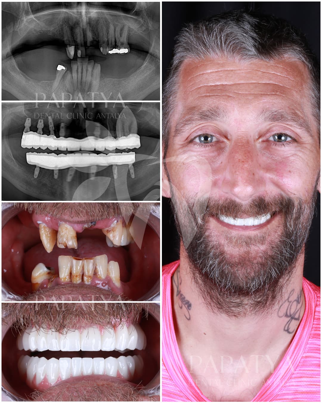 All-on-6 Implant before and after result