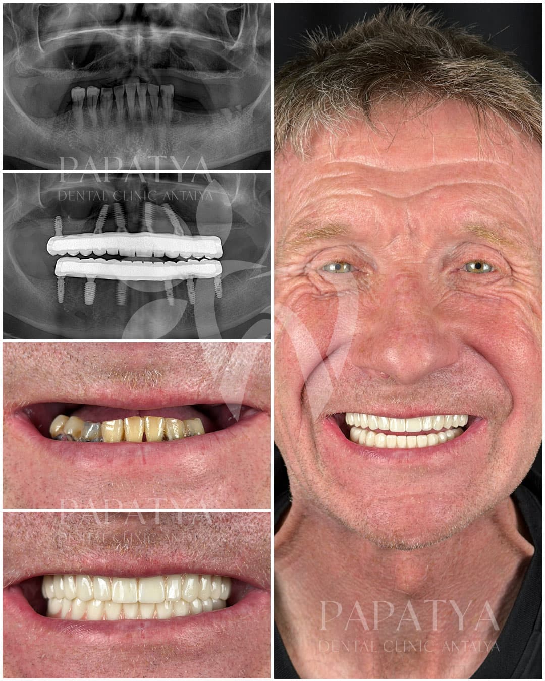 All-on-6 Implant before and after result