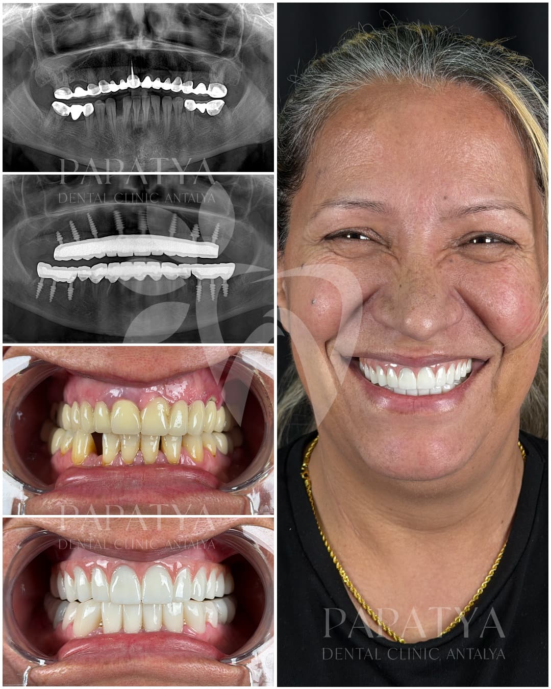 Fixed Implant-Supported Teeth in 72 Hours before and after result
