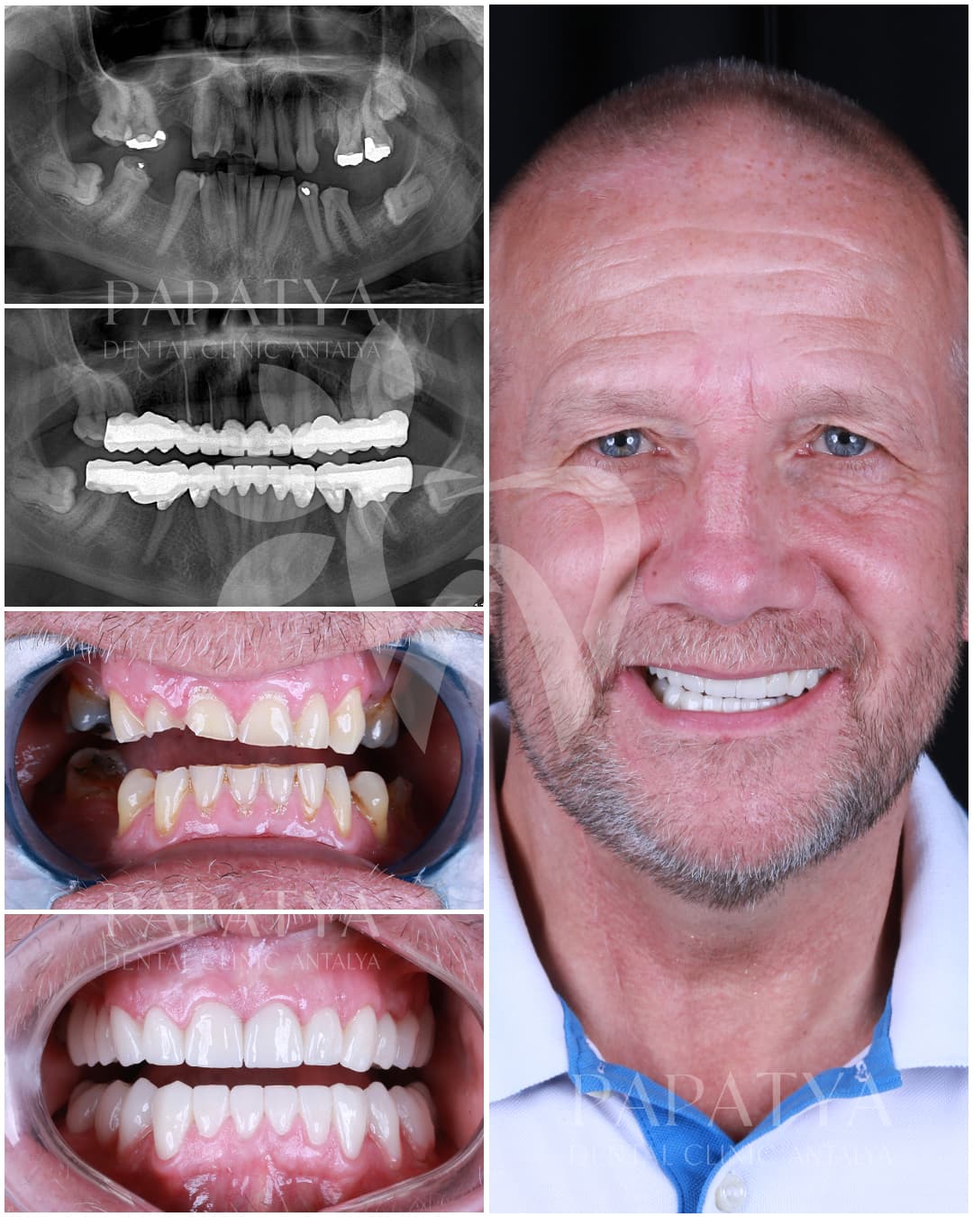 Zirconia Crown before and after result