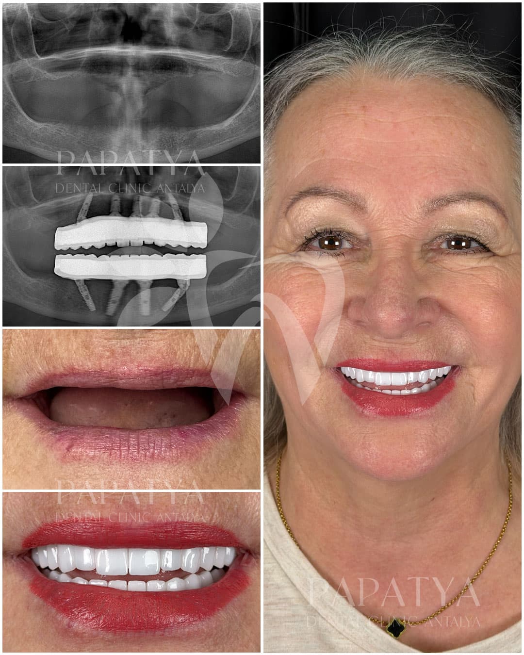 All-on-4 Implant before and after result