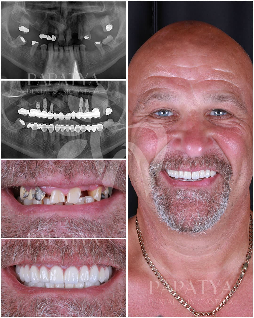 Zirconia Crown before and after result