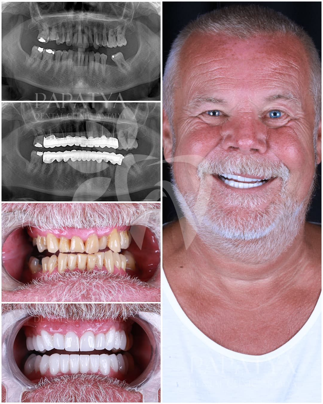 Zirconia Crown before and after result