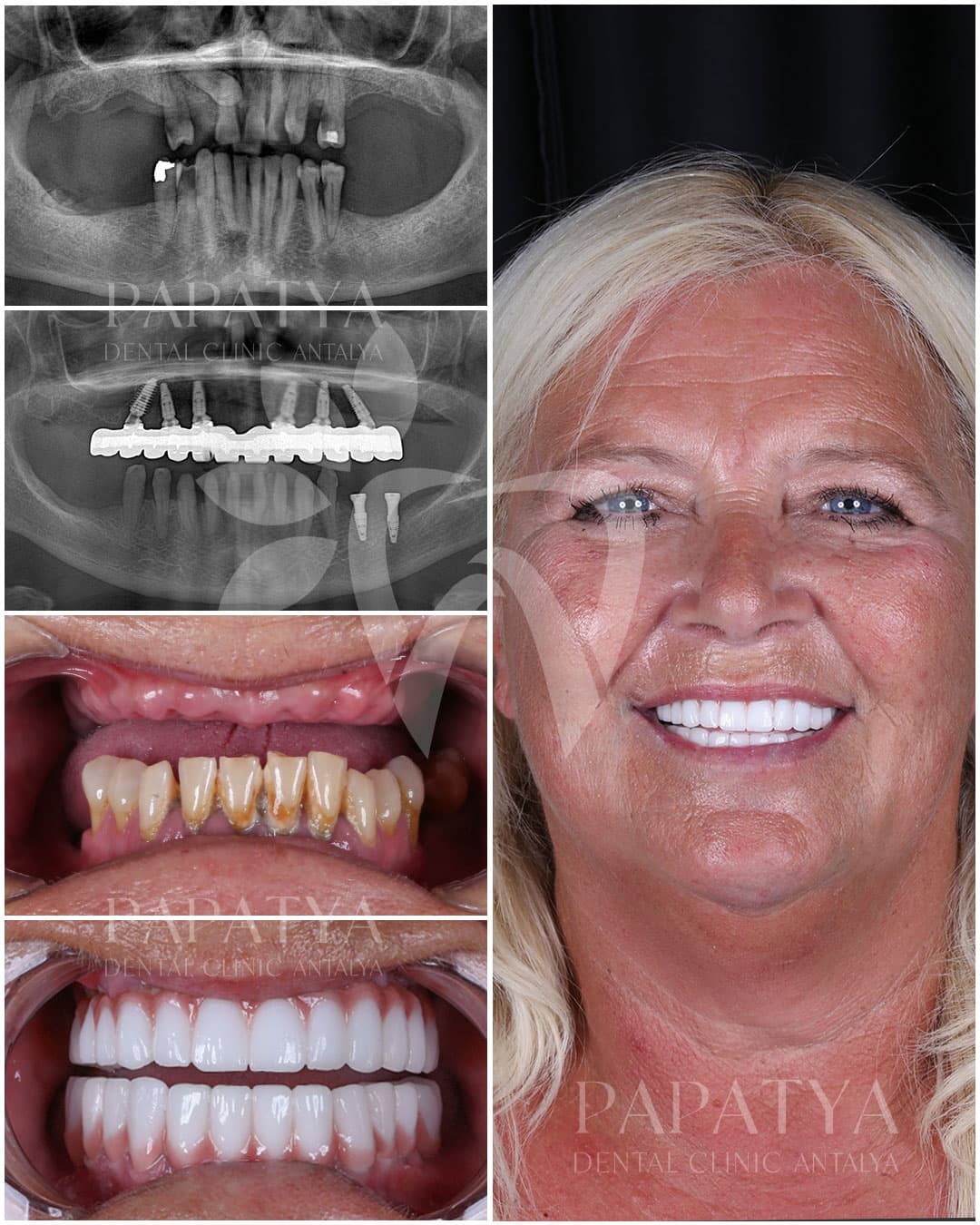 All-on-6 Implant before and after result