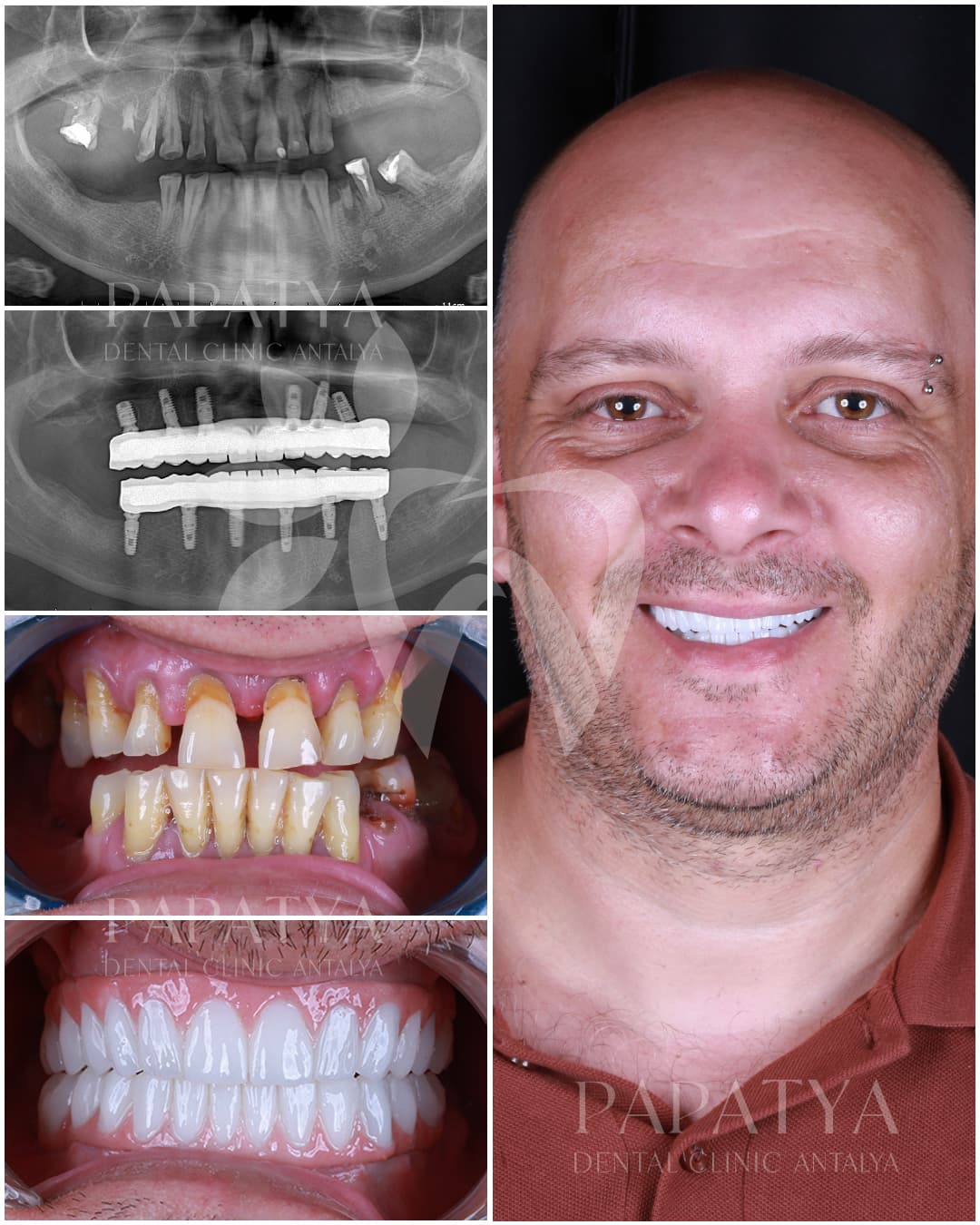 All-on-6 Implant before and after result