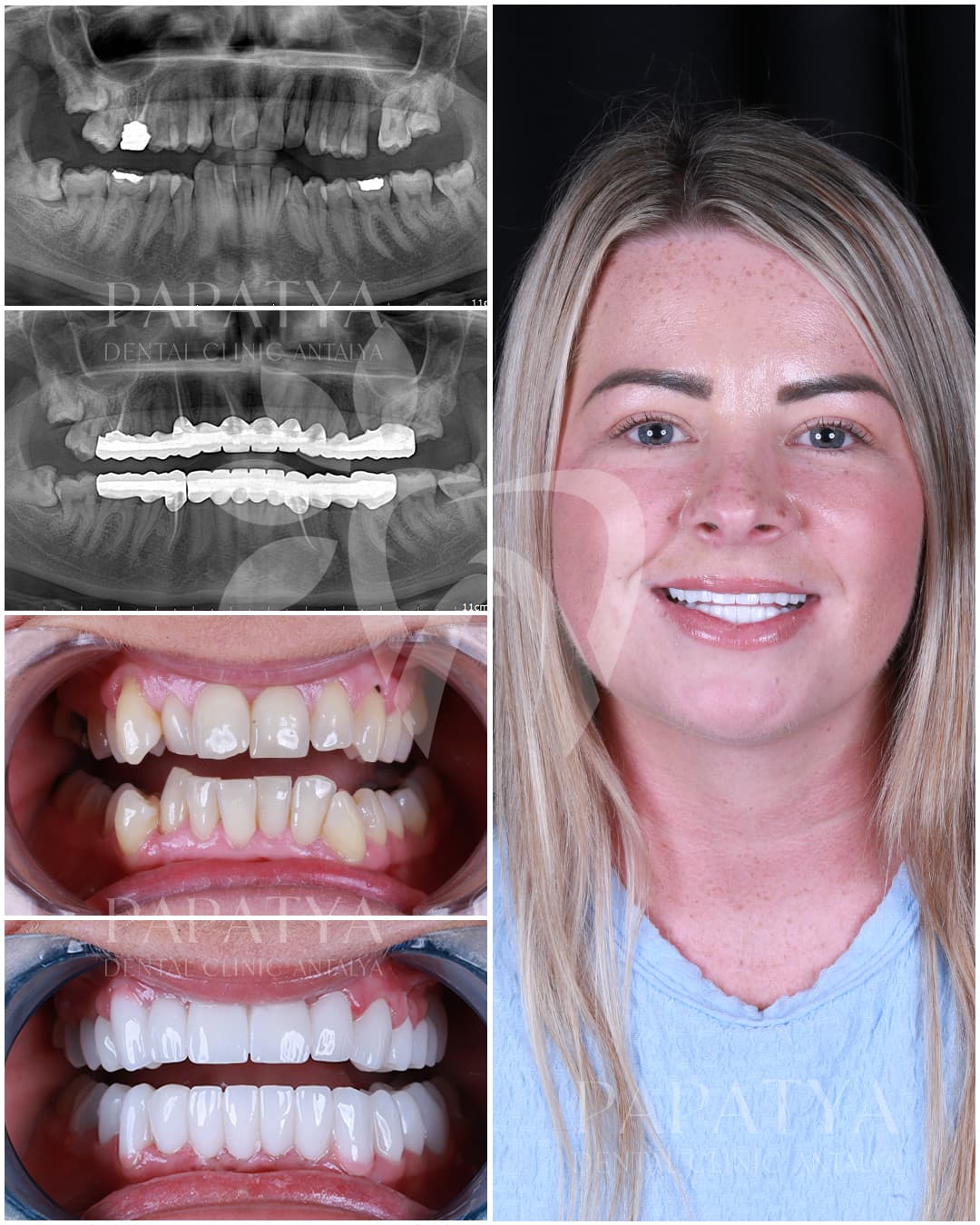 Zirconia Crown before and after result