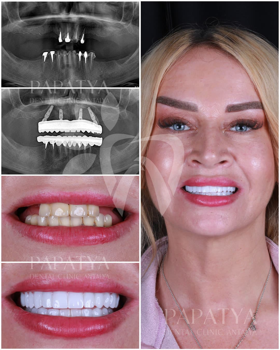 All-on-4 Implant before and after result