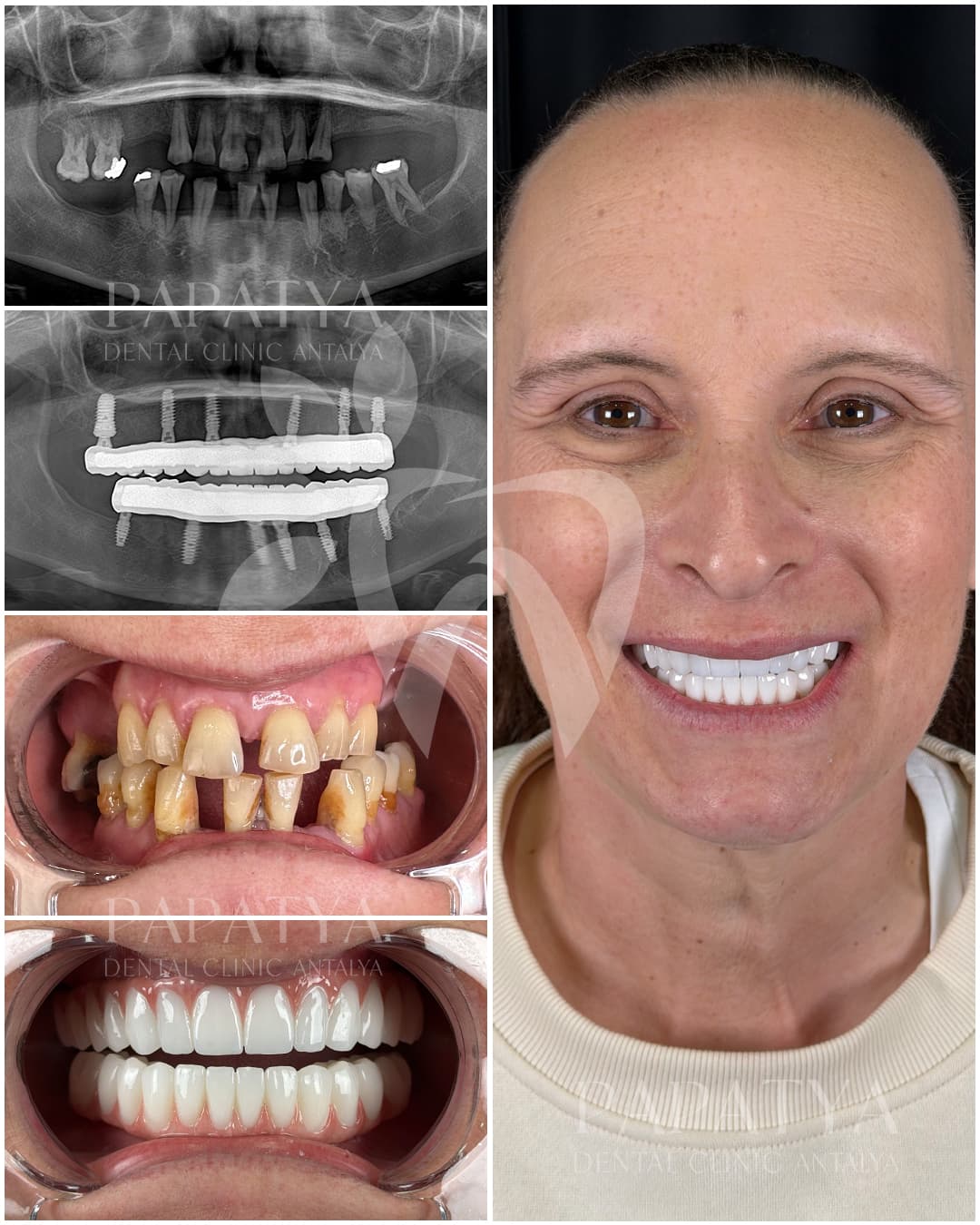 All-on-6 Implant before and after result