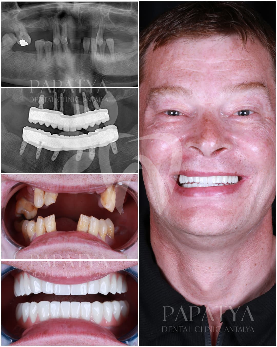 All-on-6 Implant before and after result