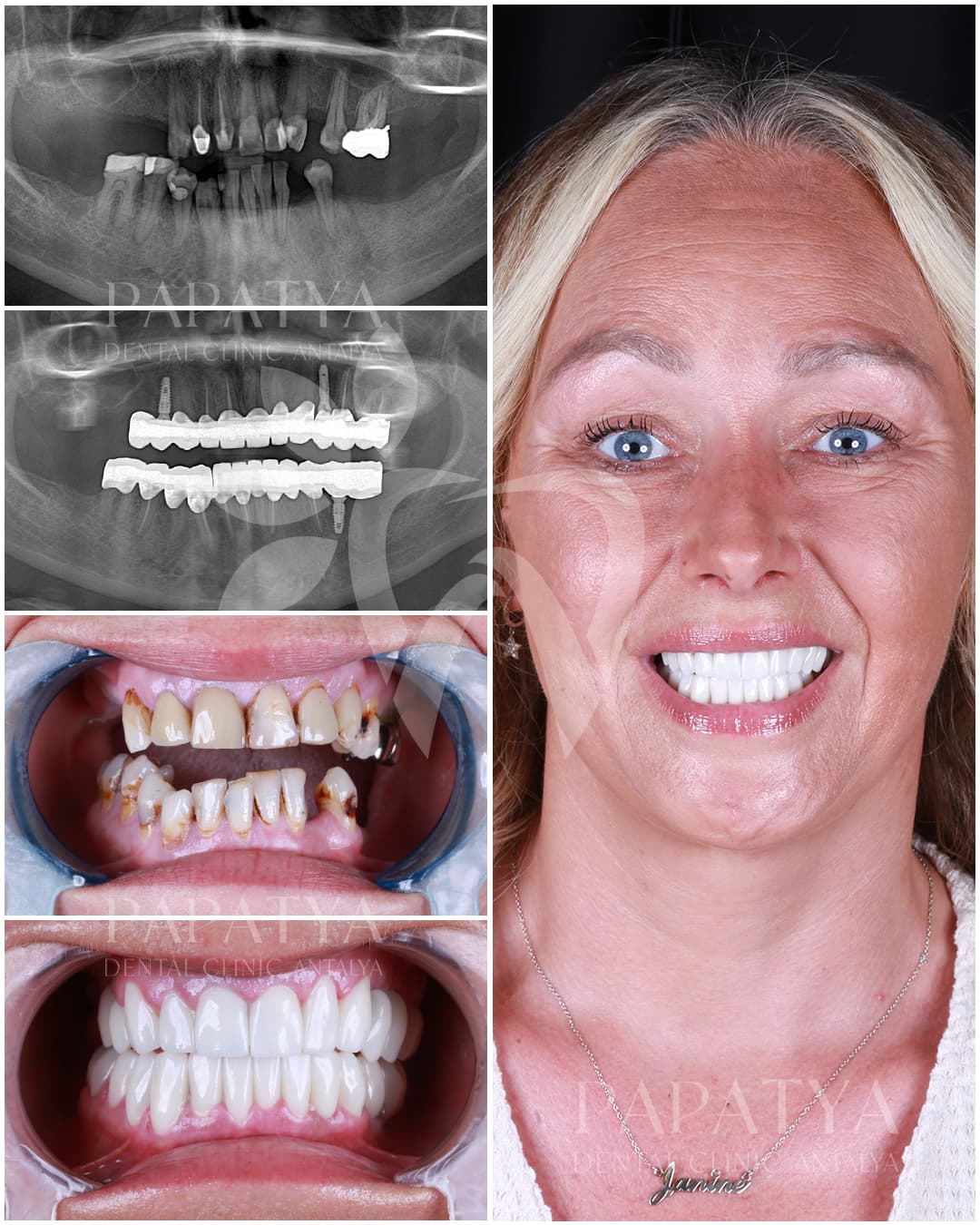 Zirconia Crown before and after result