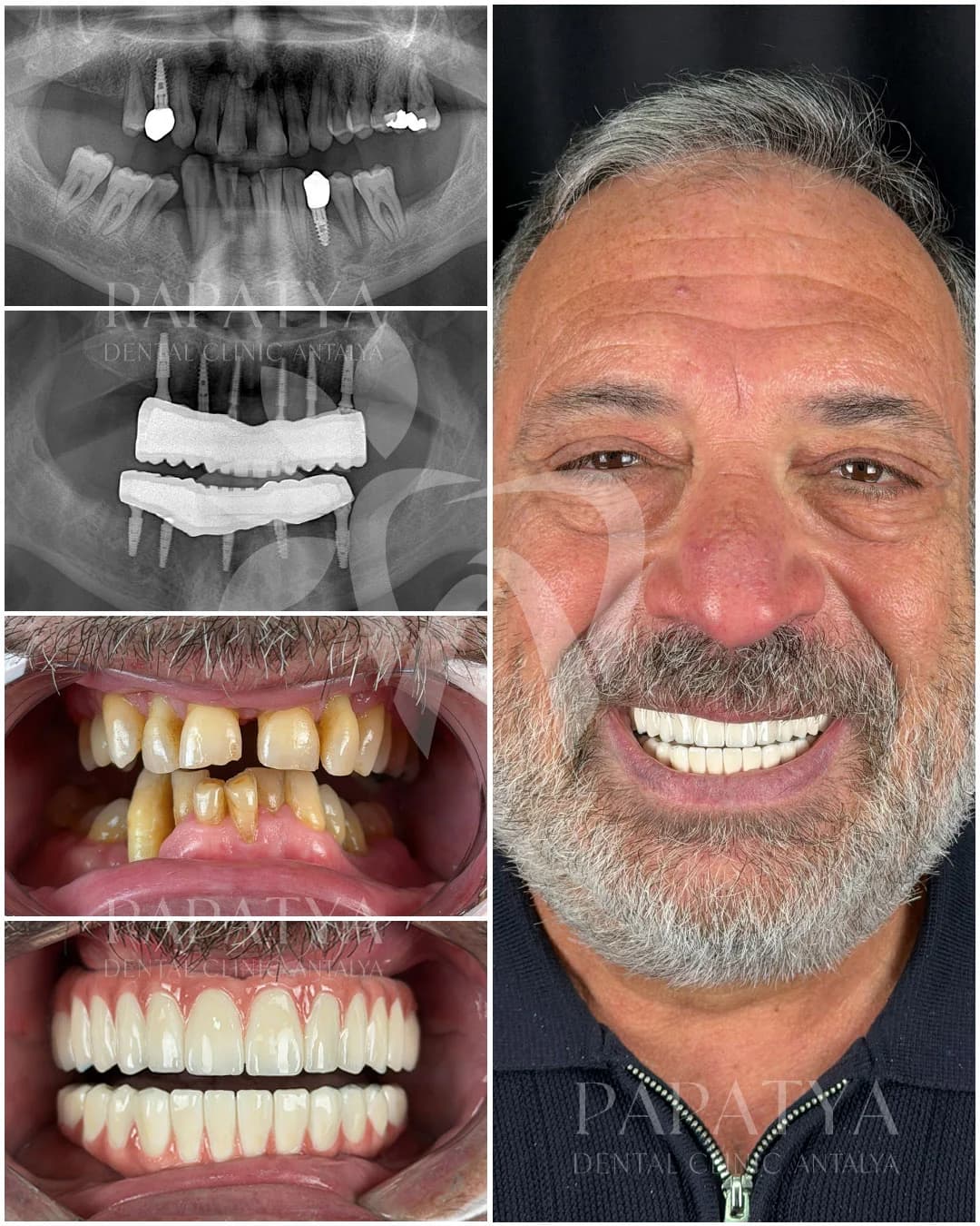 All-on-6 Implants before and after result