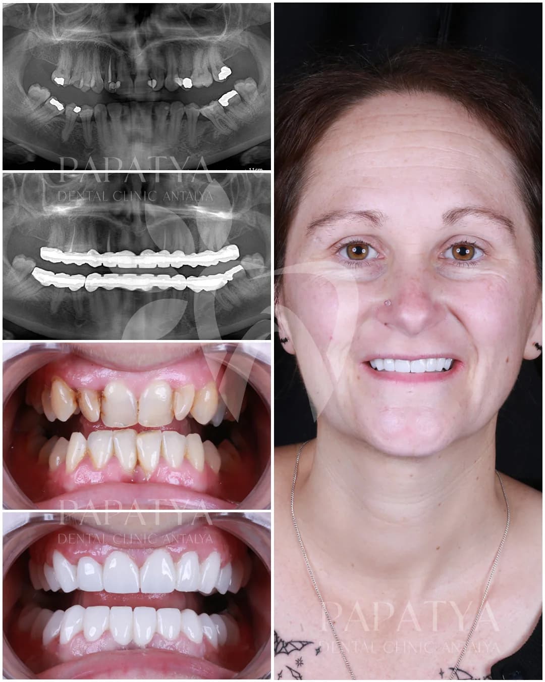 Hollywood Smile Design before and after result
