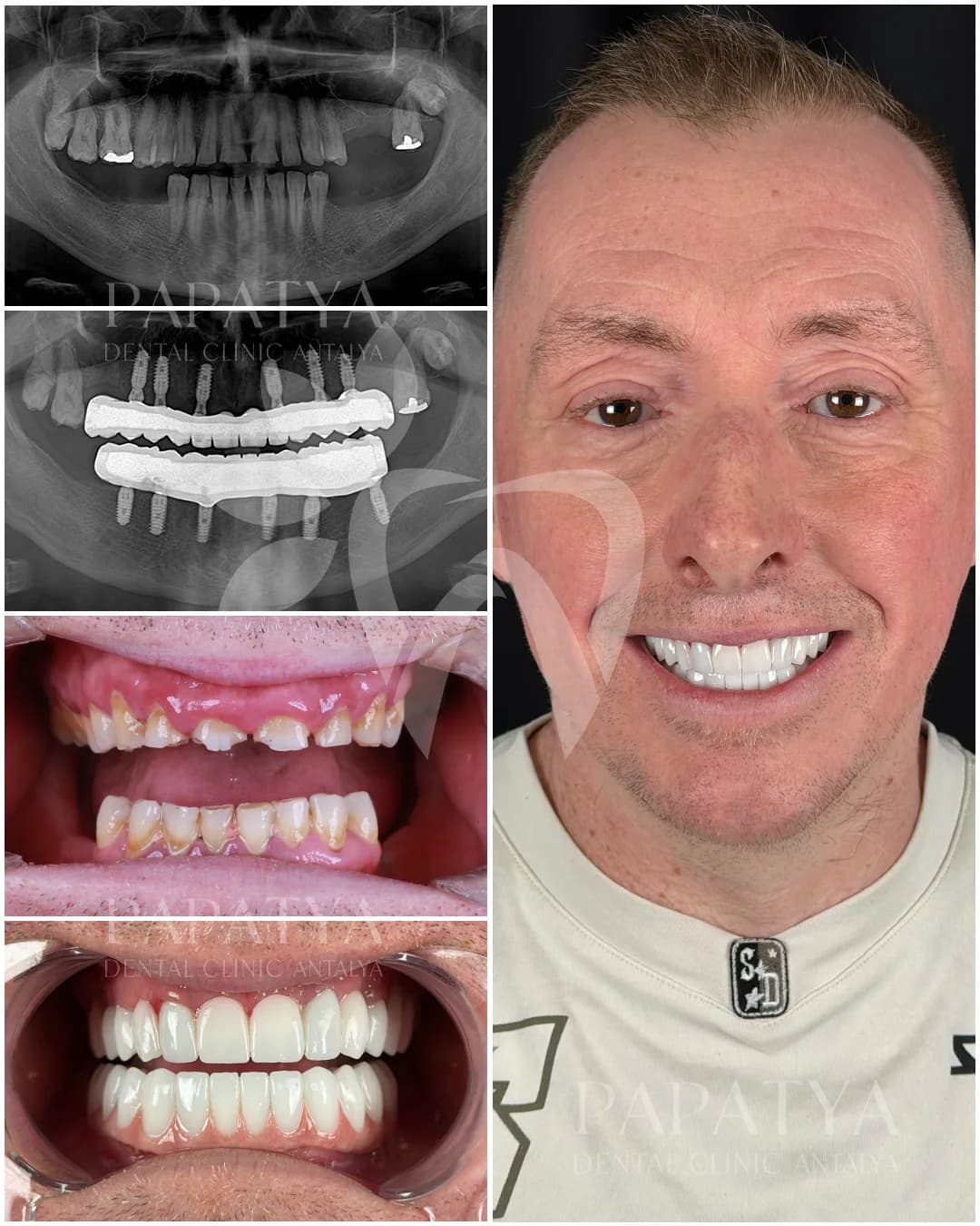 All-on-6 Implants before and after result
