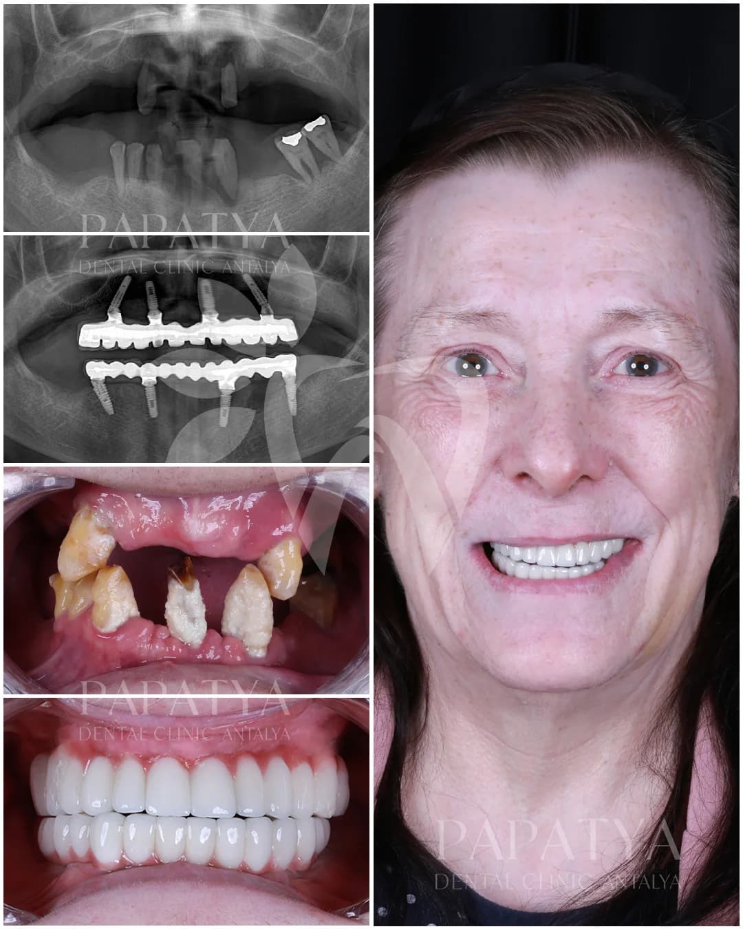 All-on-4 Implants before and after result
