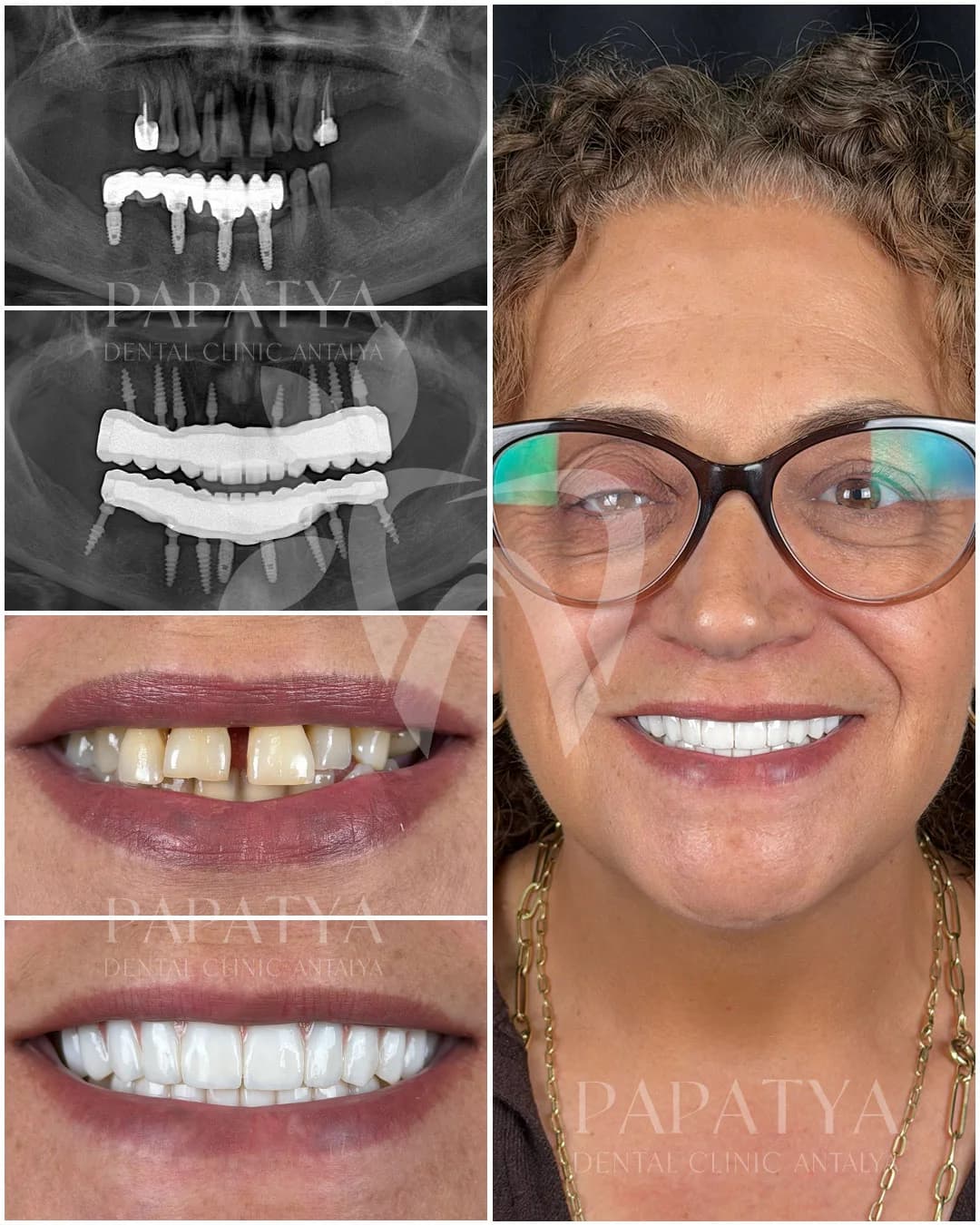 Fixed Teeth on Implants in 72 Hours before and after result