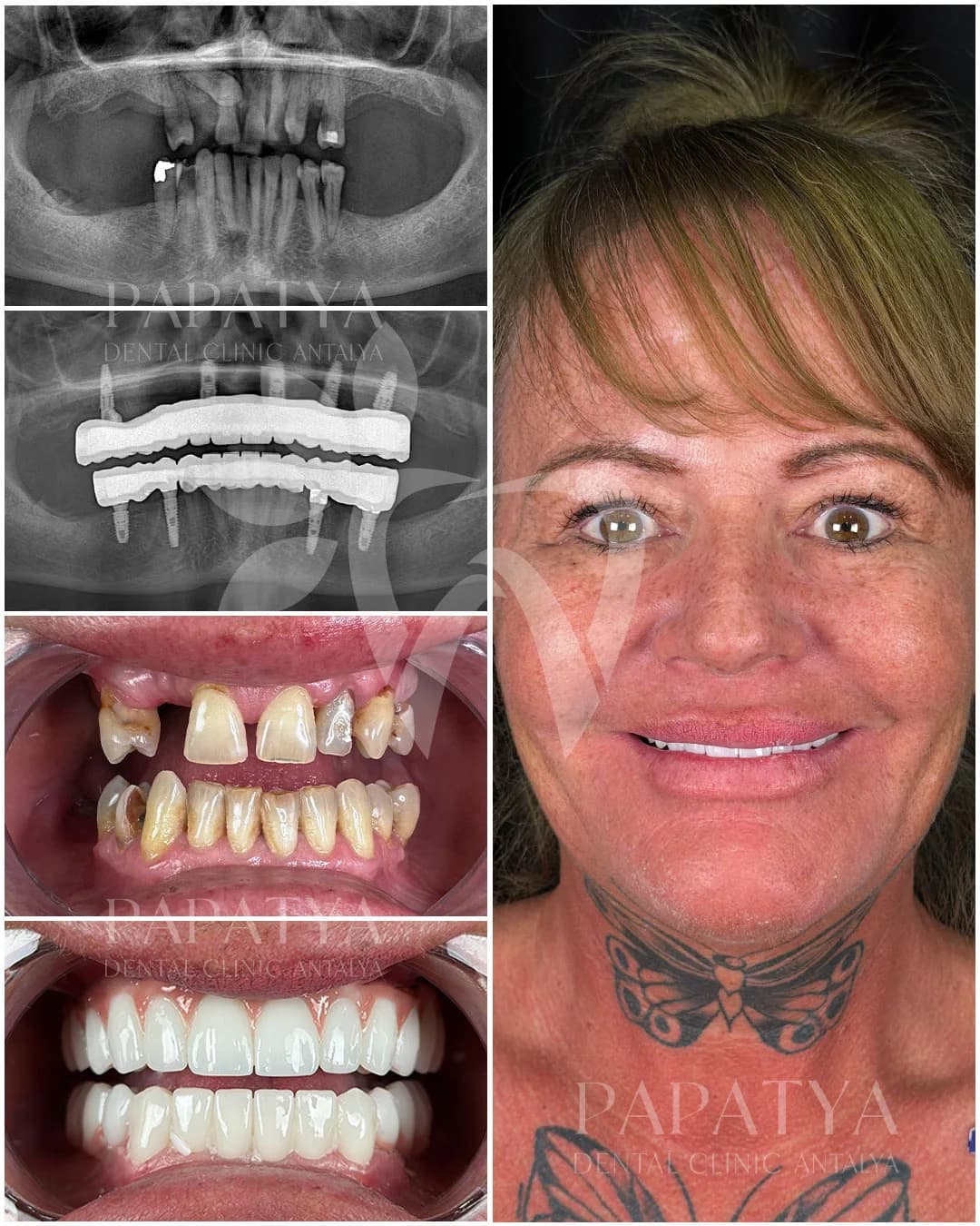All-on-4 Implants before and after result