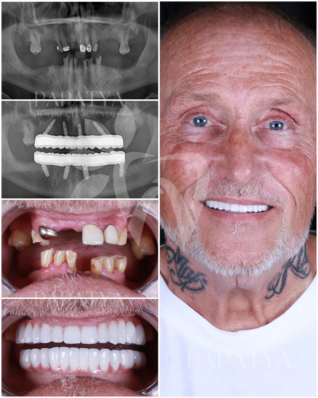 All-on-4 Implants before and after result