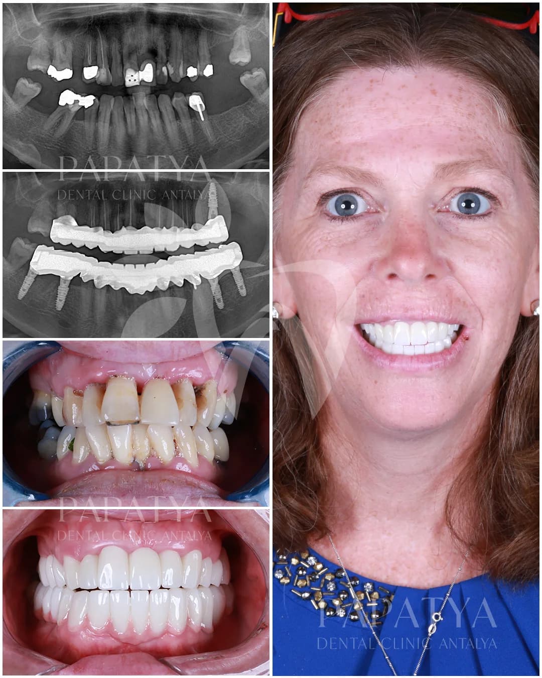 All-on-4 Implants before and after result