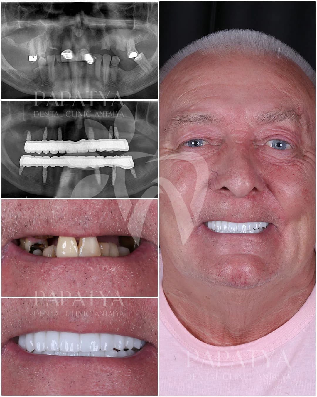 All-on-6 Implants before and after result