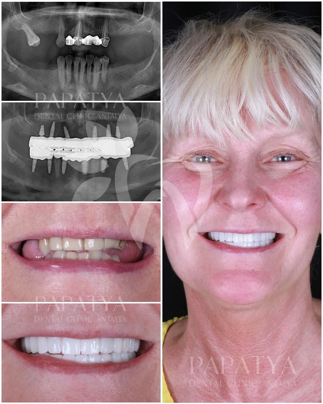 All-on-6 Implants before and after result
