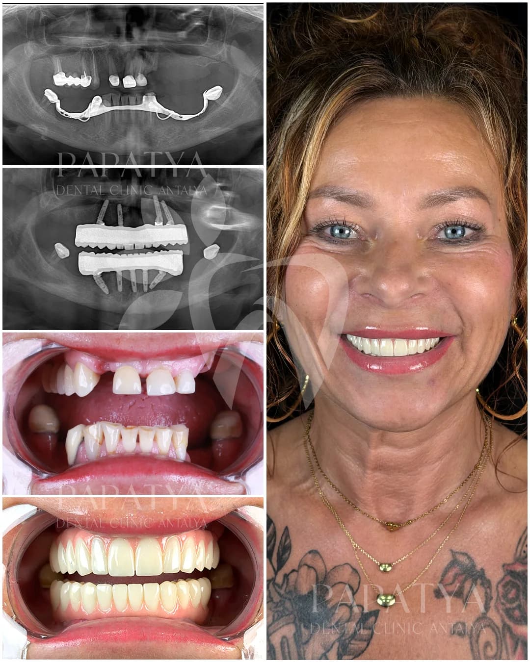 All-on-4 Implants before and after result