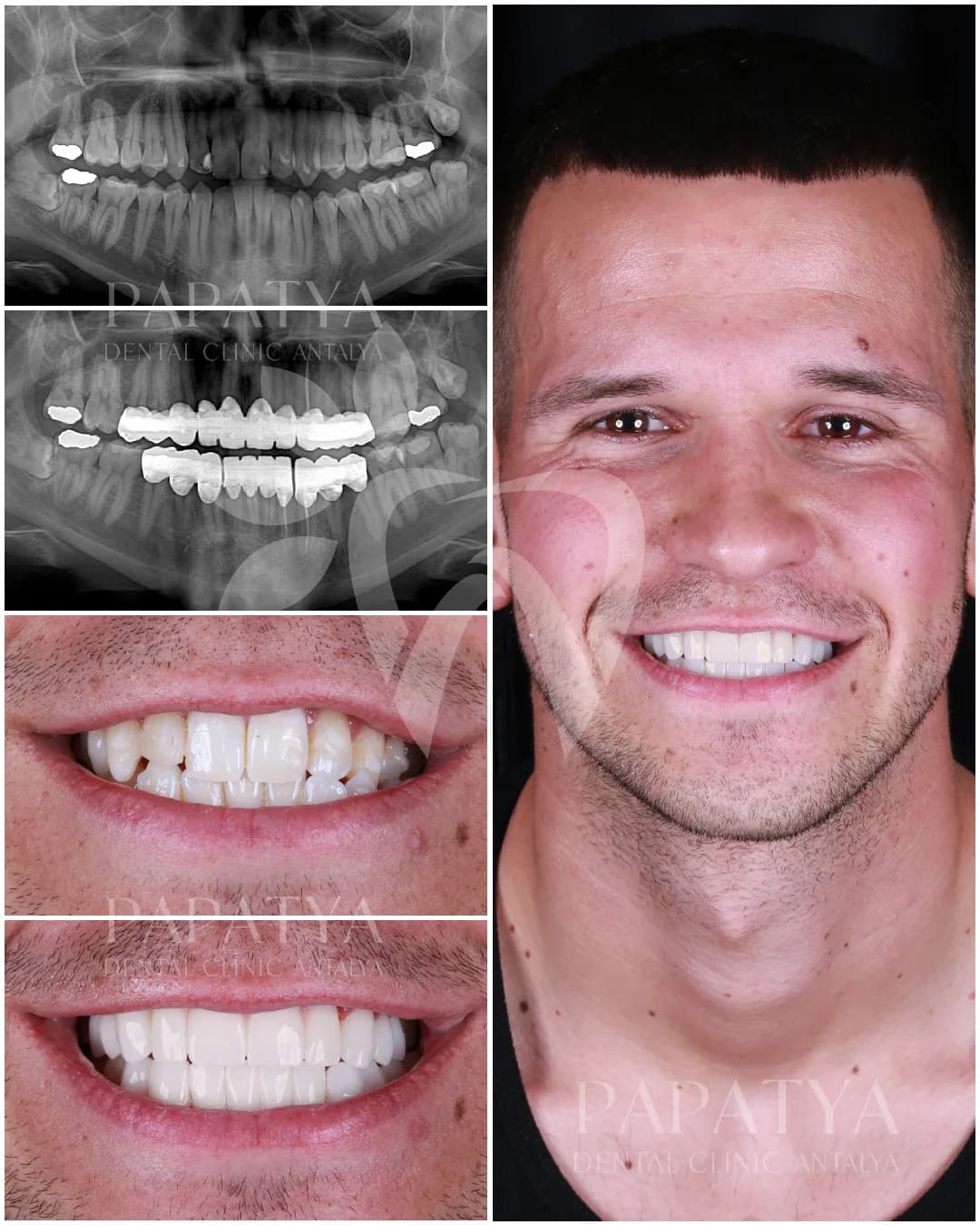 Zirconium Crowns before and after result
