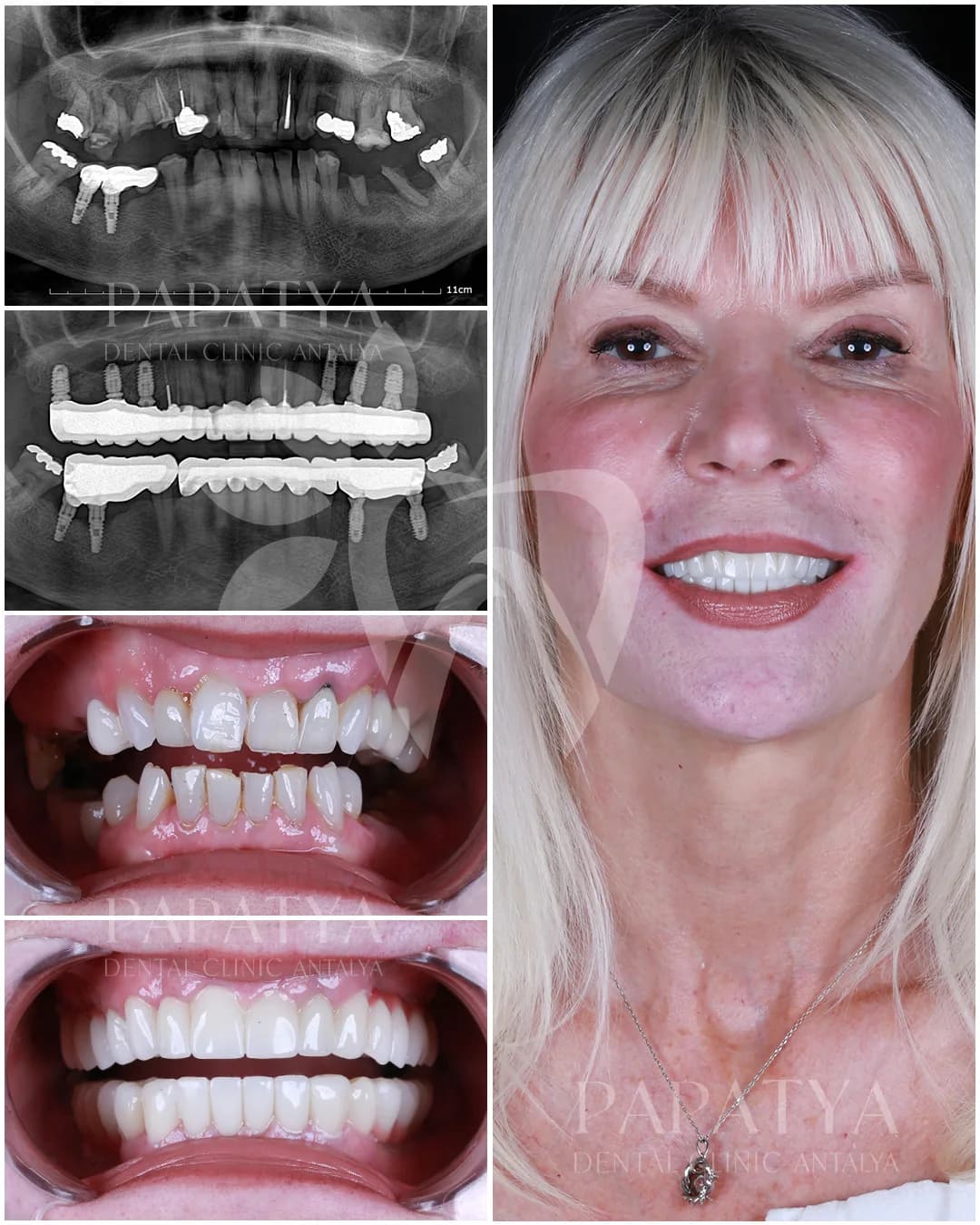All-on-4-Implantate before and after result