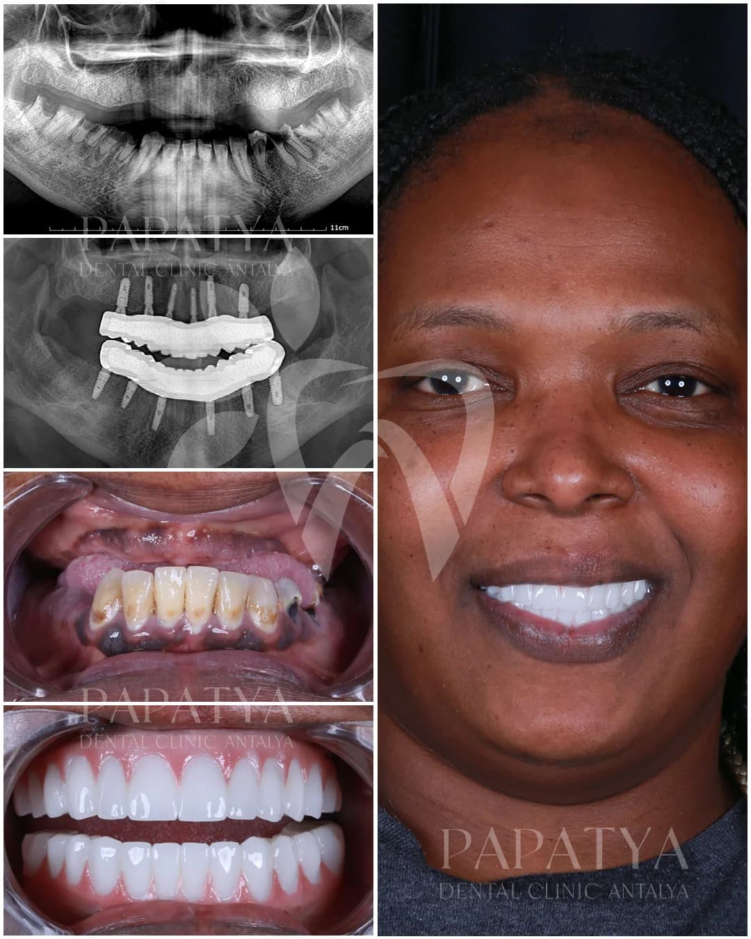 All-on-6-Implantate before and after result