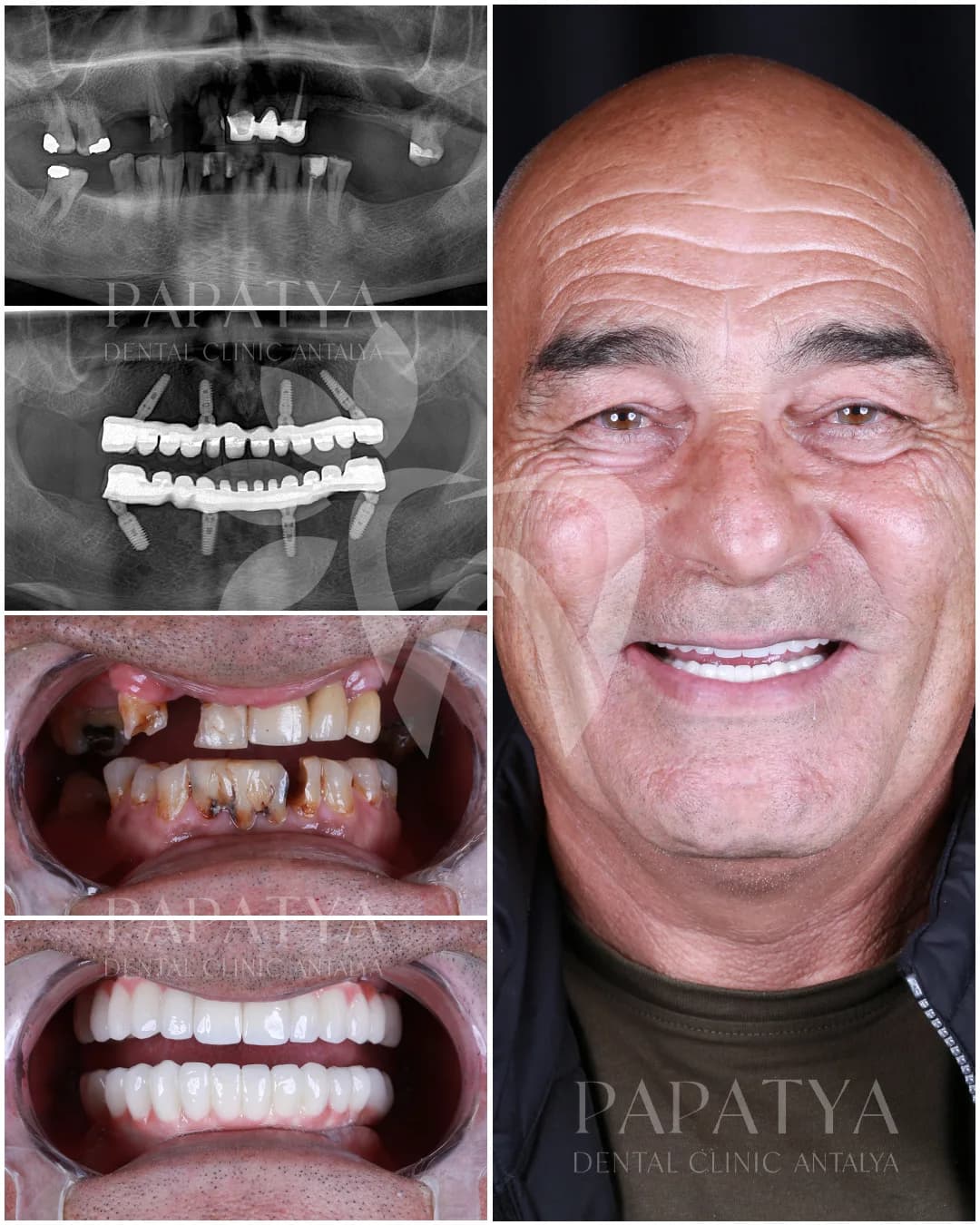 All-on-4-Implantate before and after result