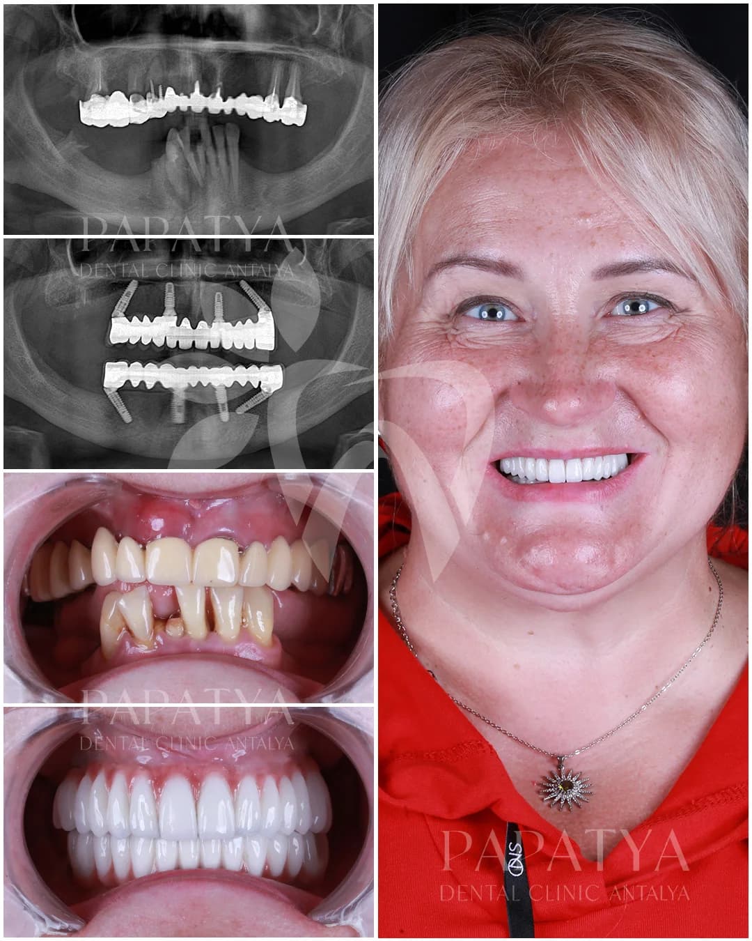 All-on-4-Implantate before and after result