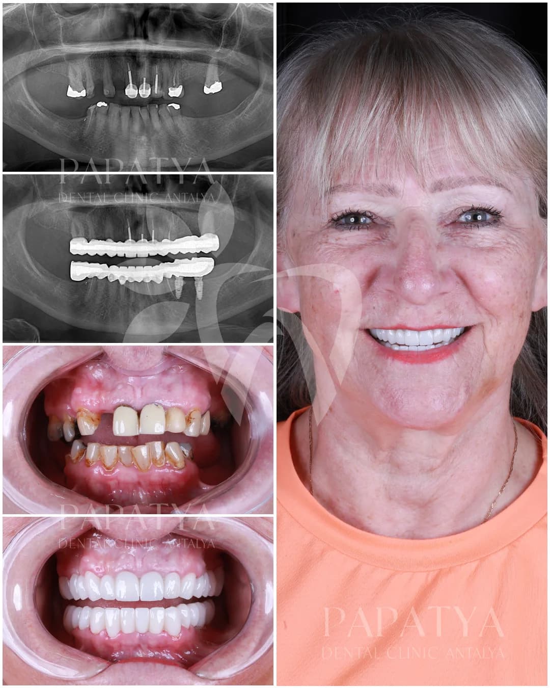 Zirkonverblendungen before and after result