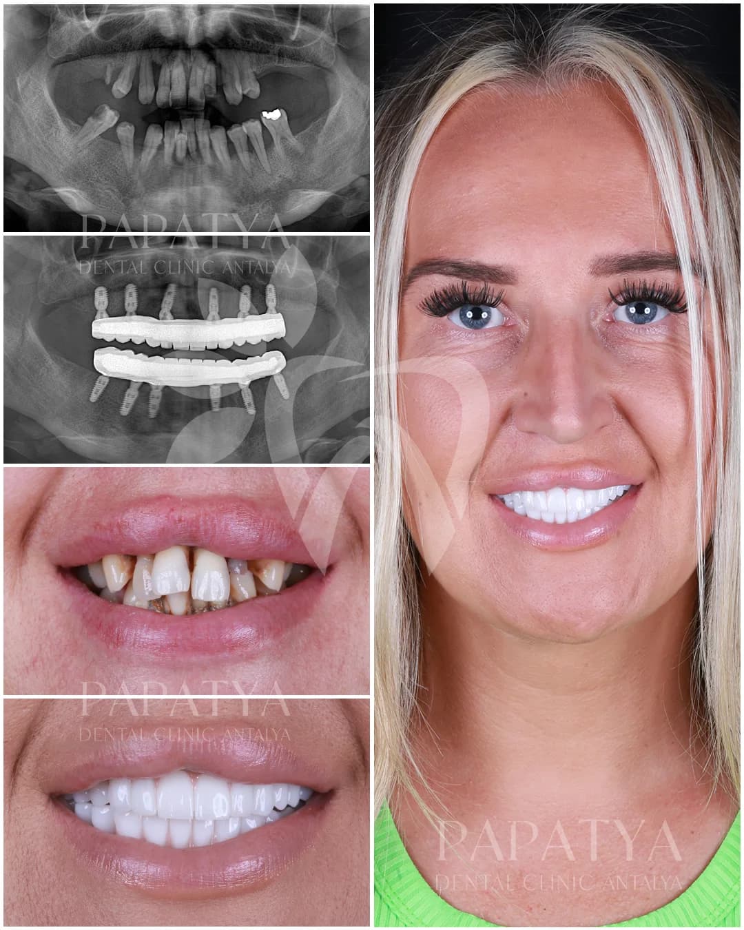 All-on-6-Implantate before and after result