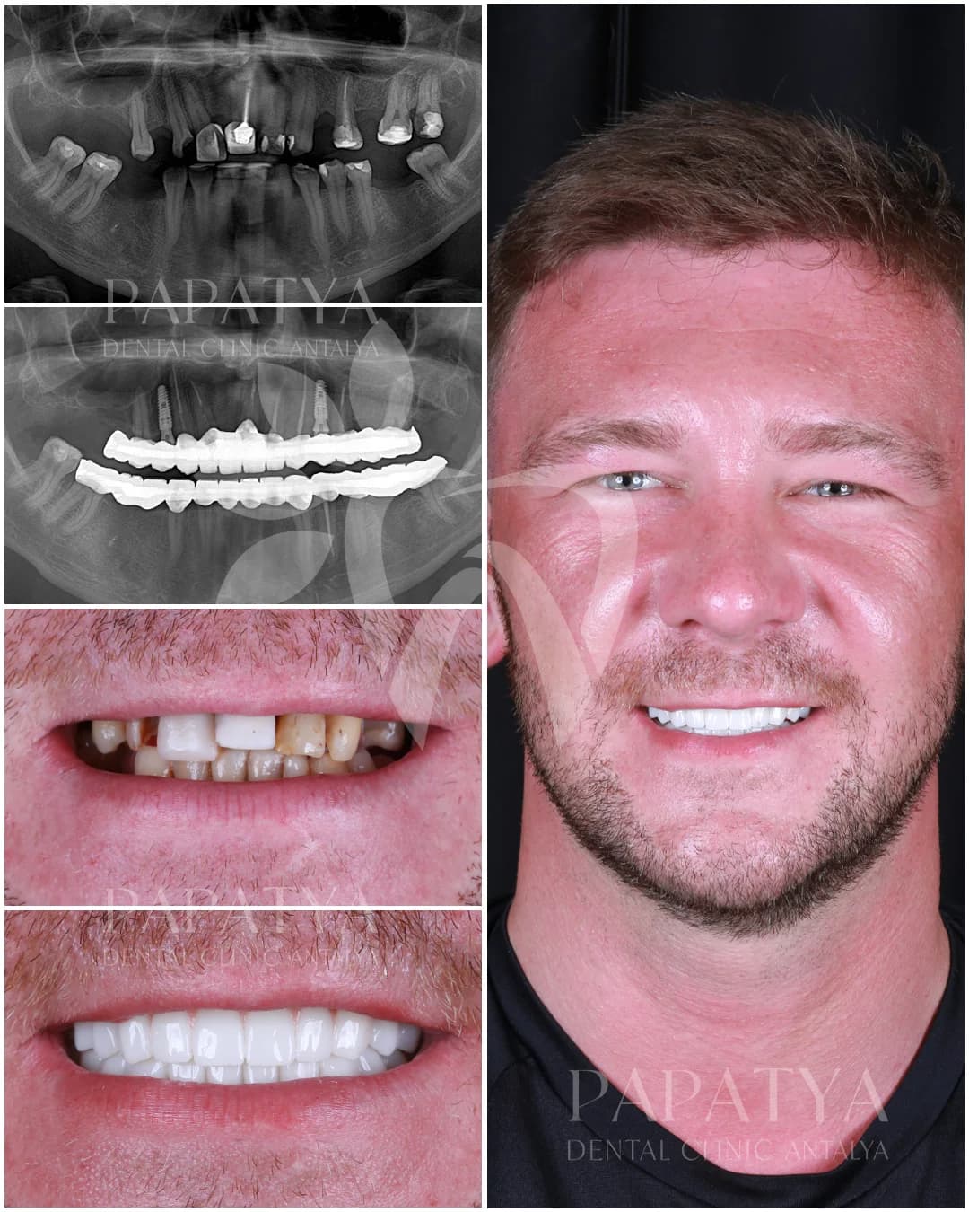 Zahnimplantat before and after result