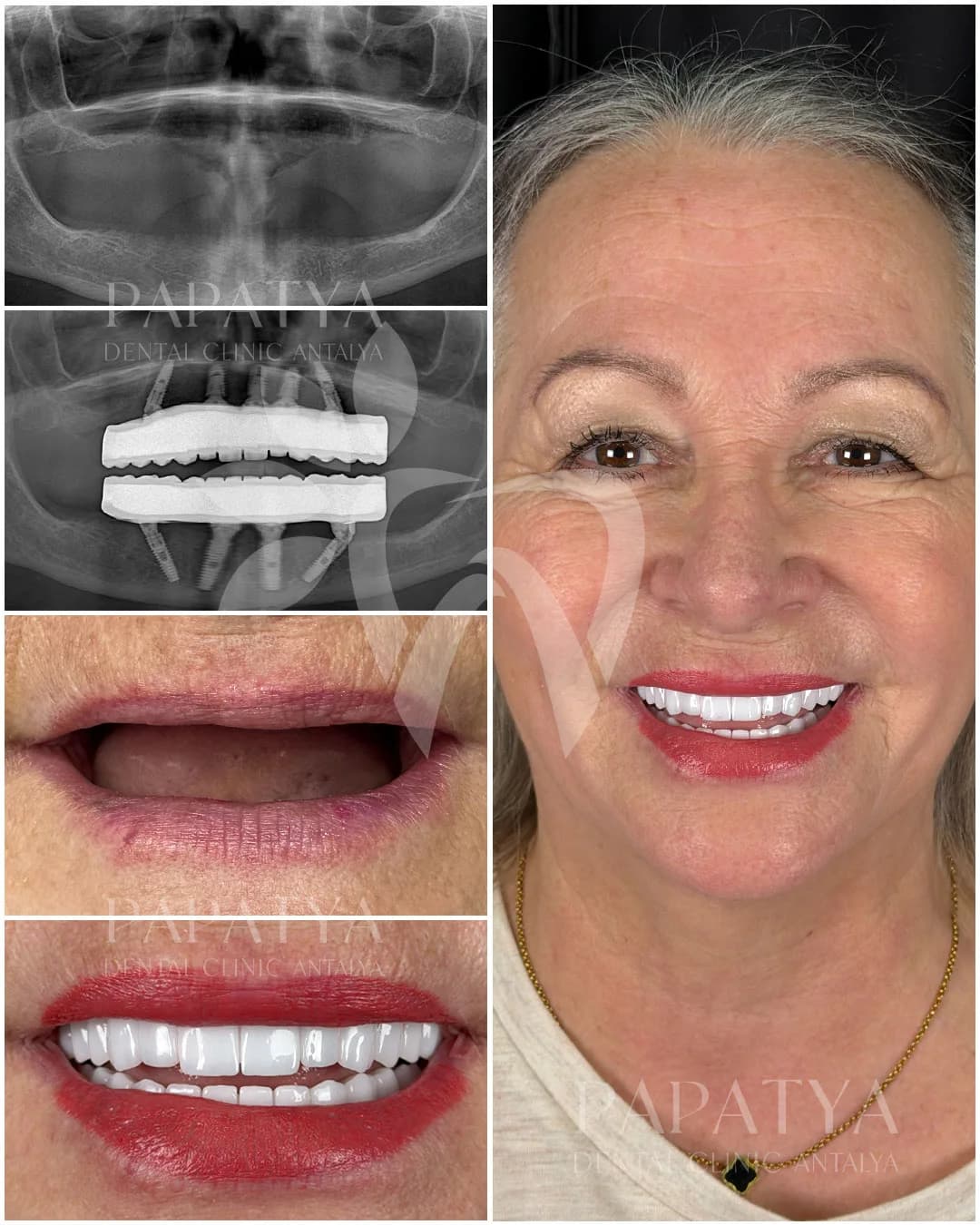 All-on-4-Implantate before and after result