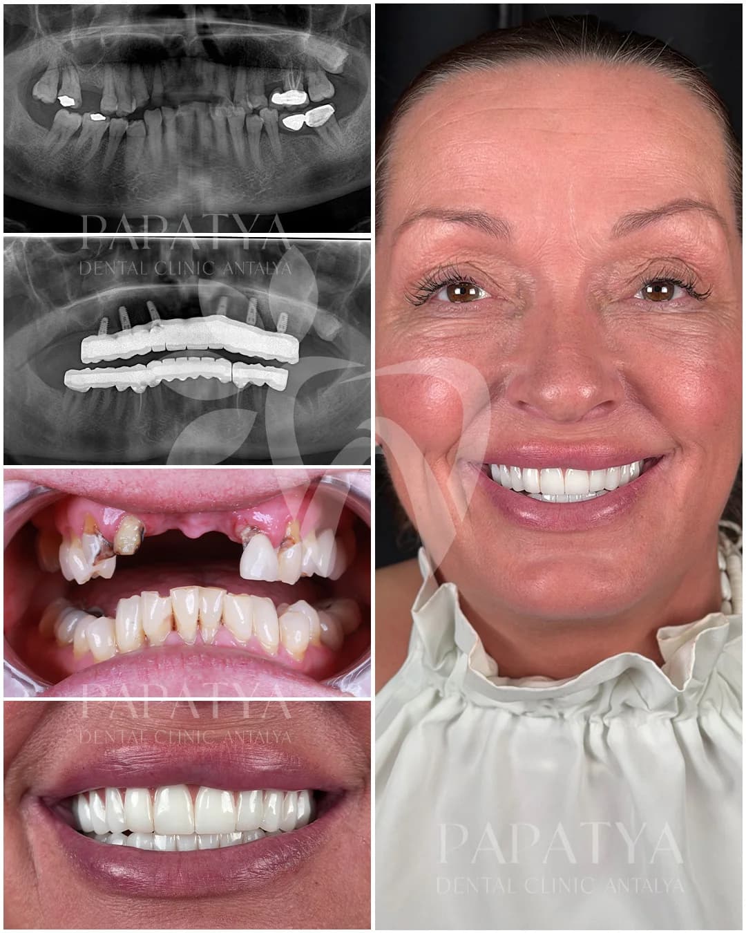 All-on-6-Implantate before and after result