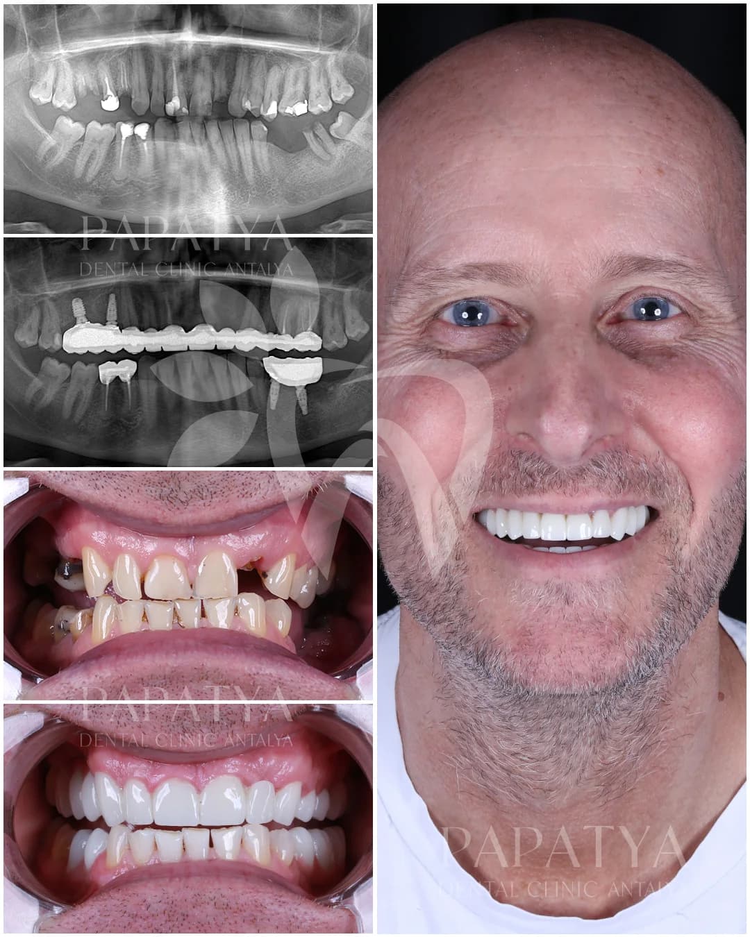 All-on-4-Implantate before and after result