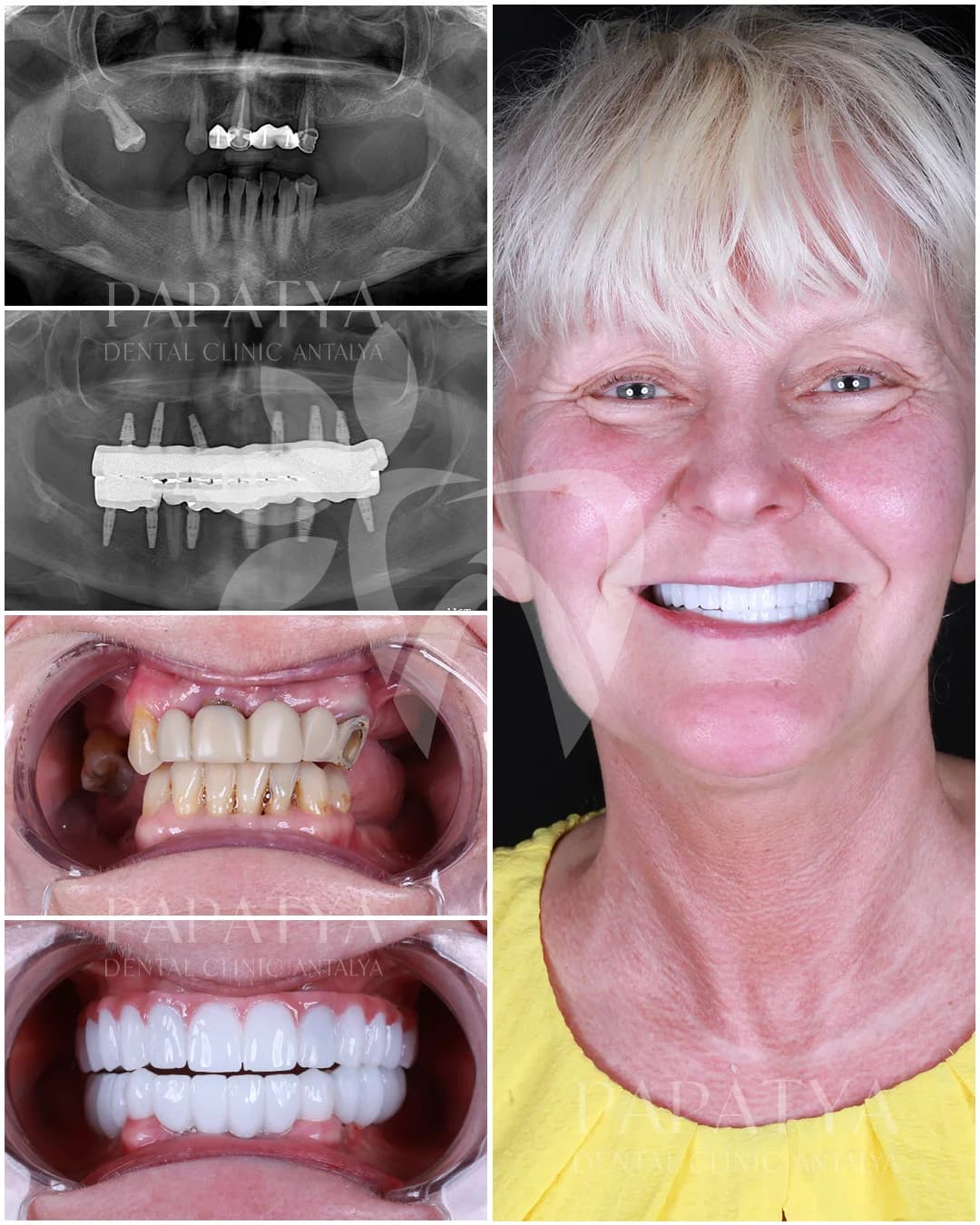 All-on-6-Implantate before and after result