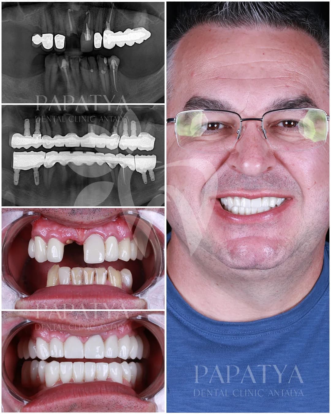 All-on-4-Implantate before and after result