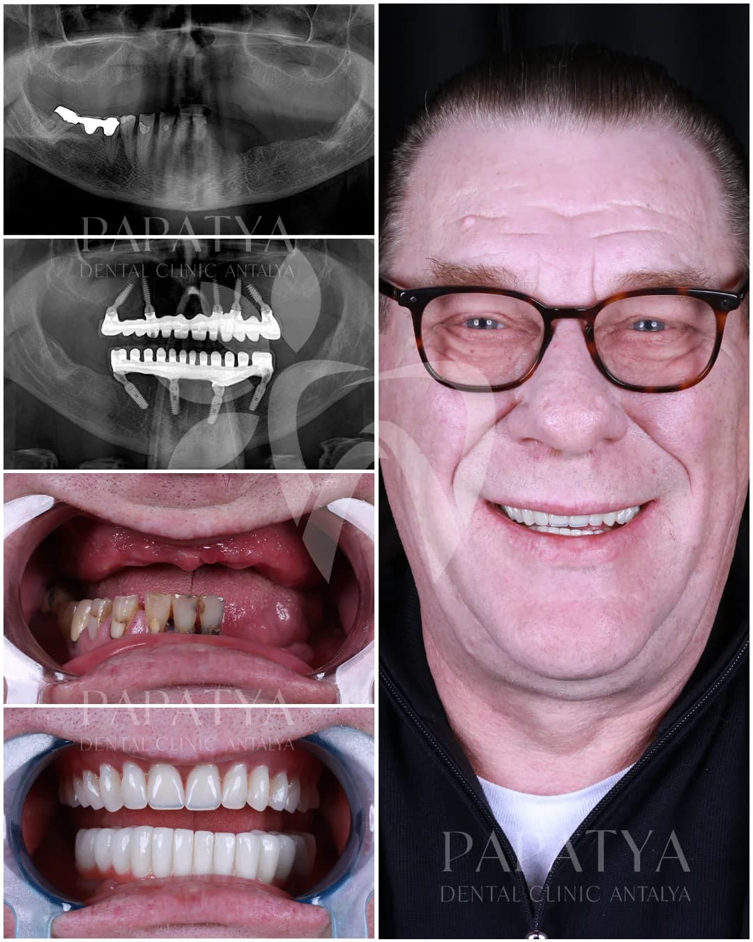 All-on-4-Implantate before and after result