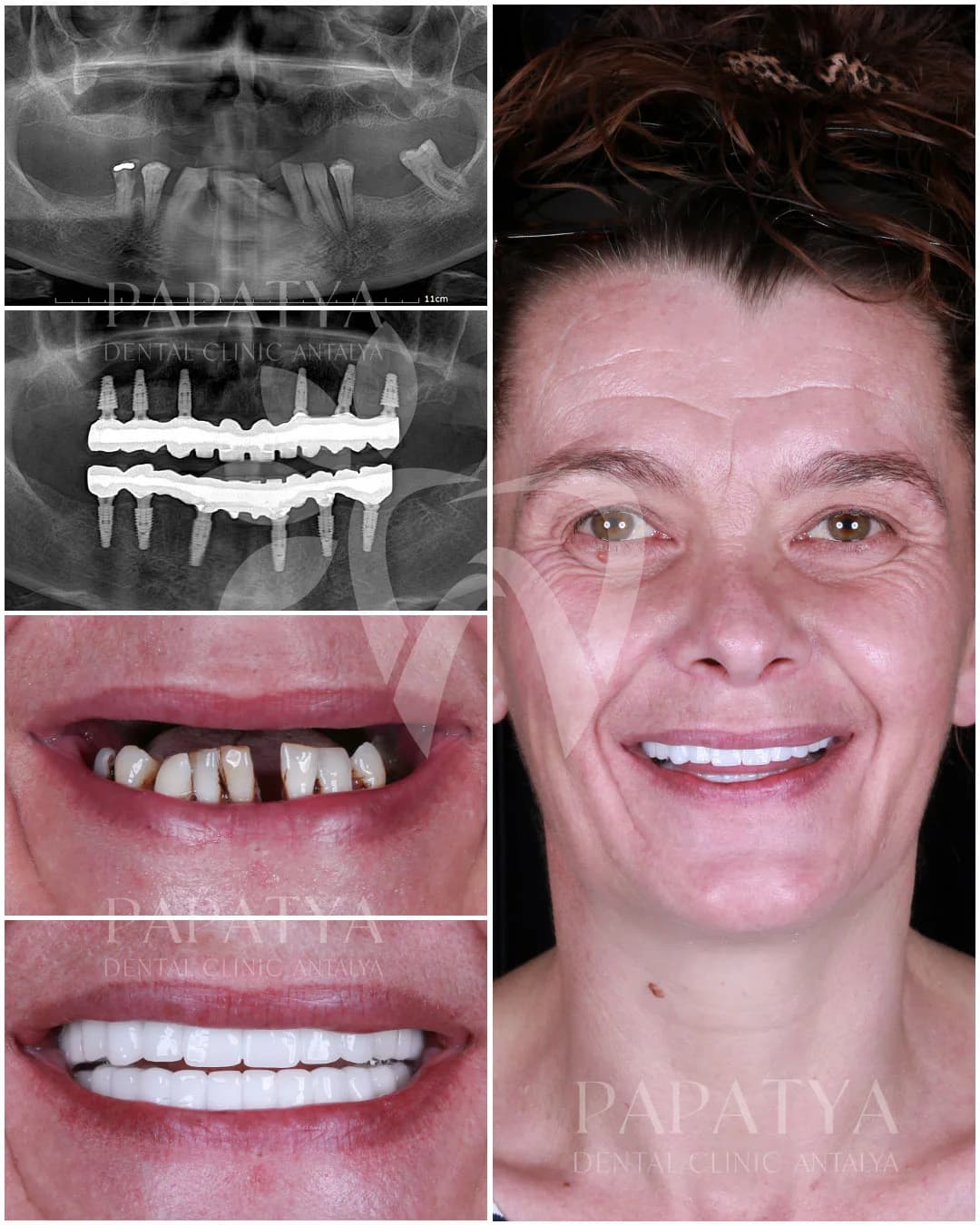 All-on-6-Implantate before and after result