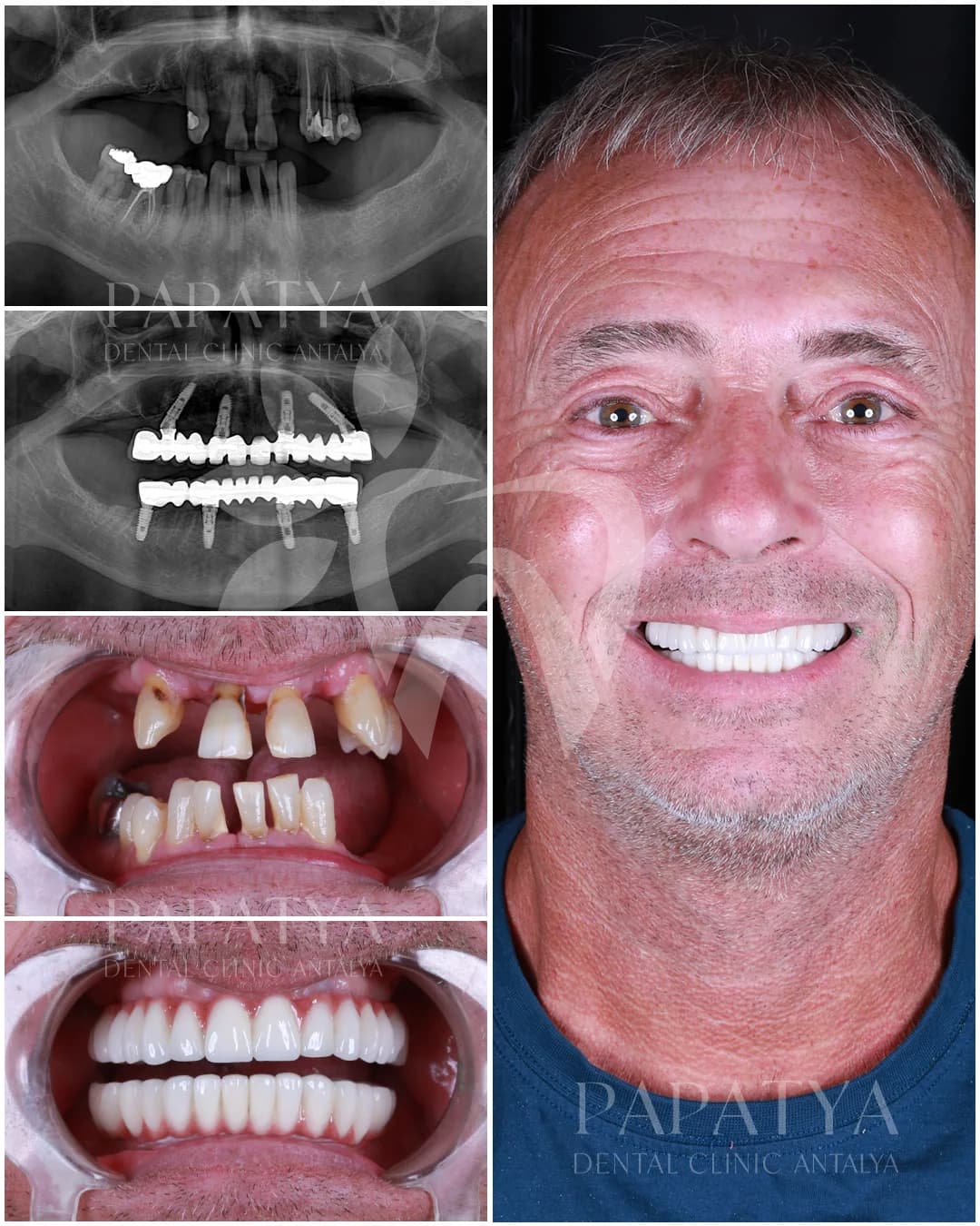 All-on-4-Implantate before and after result