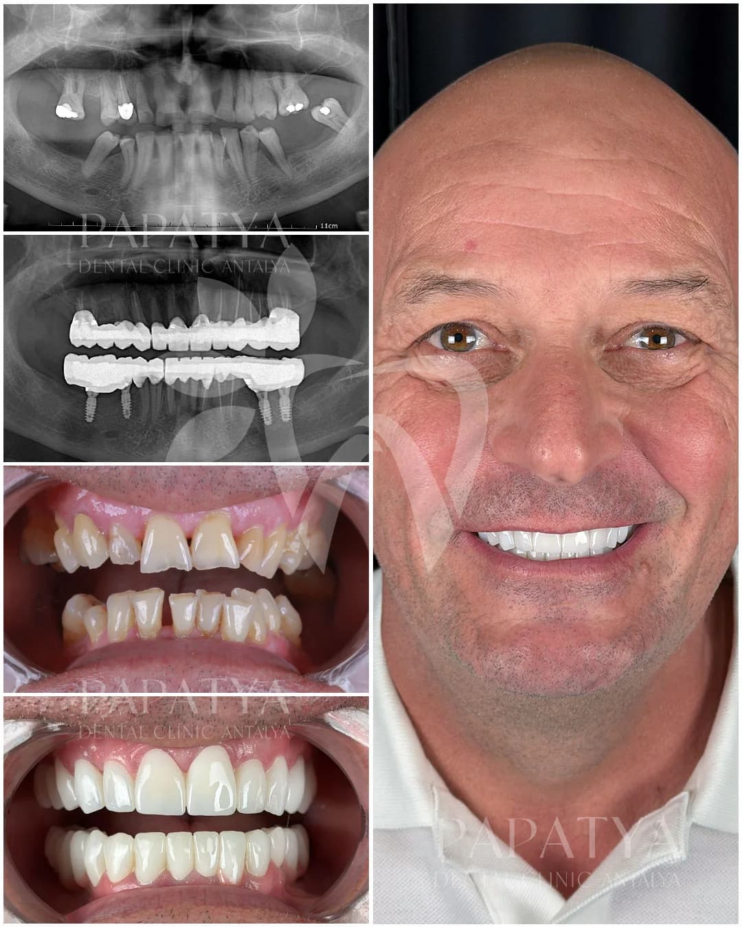 Zahnimplantat before and after result