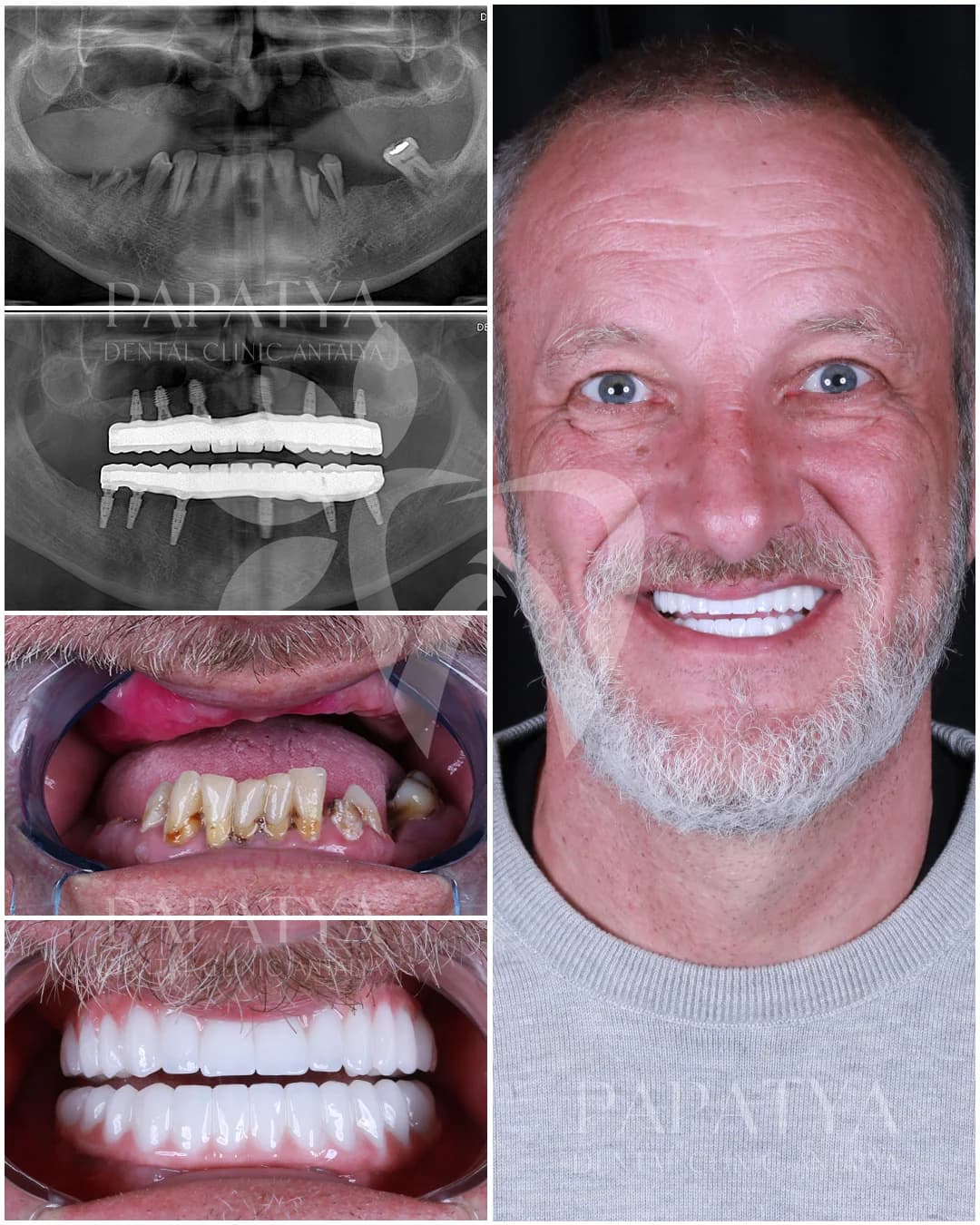 All-on-6-Implantate before and after result