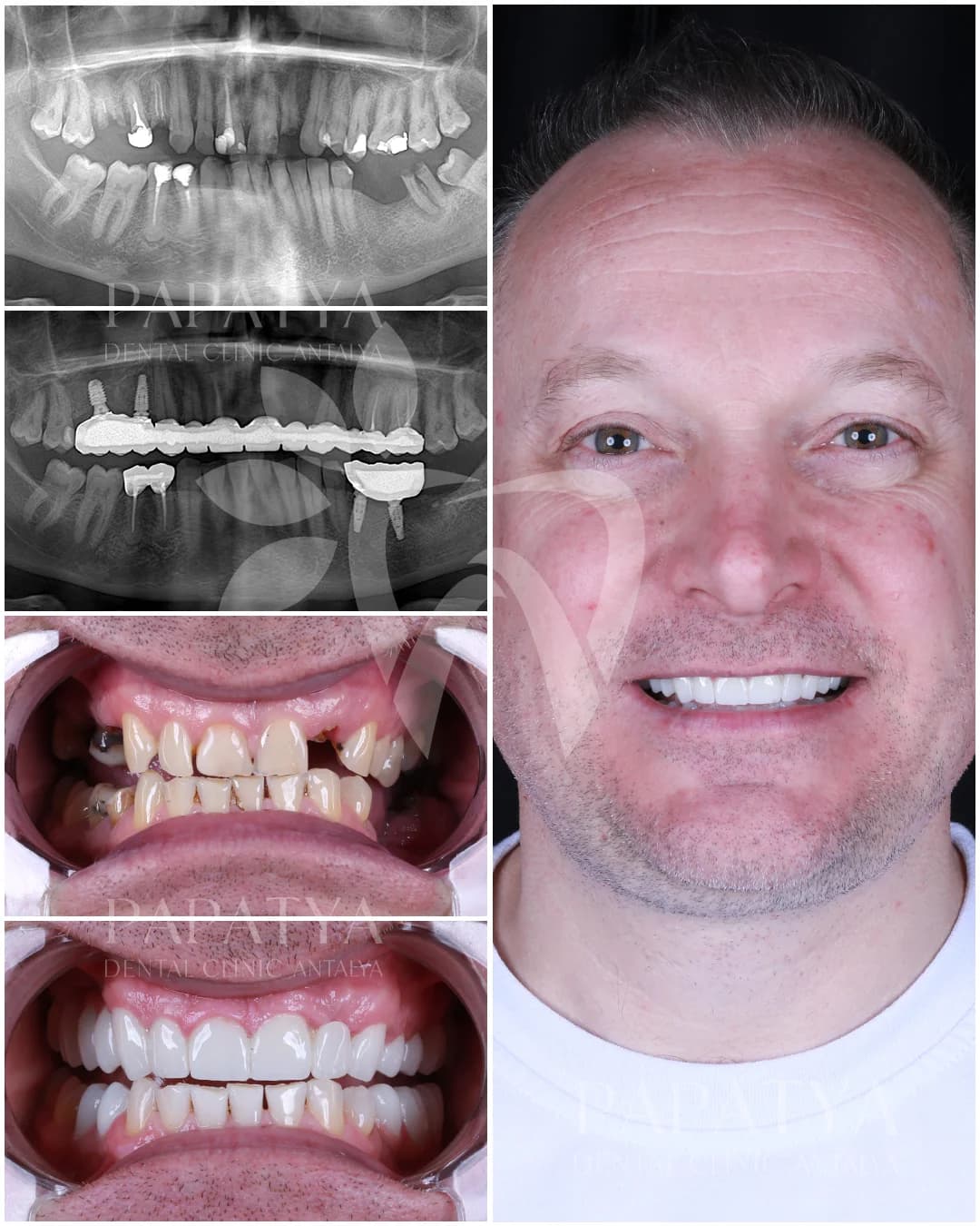 Zahnimplantat before and after result