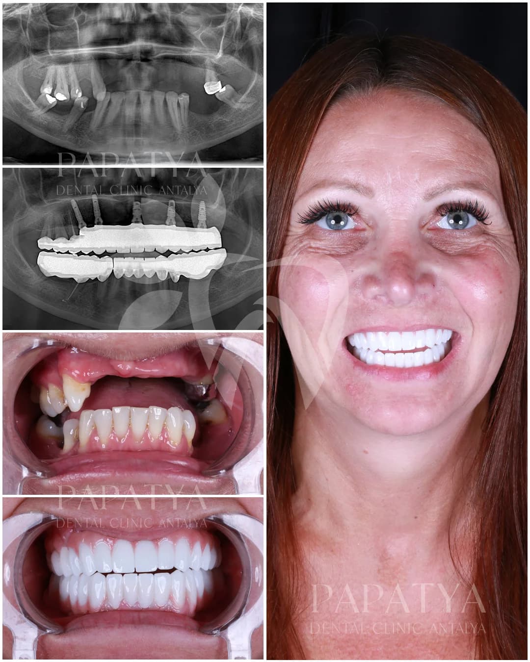 All-on-6-Implantate before and after result