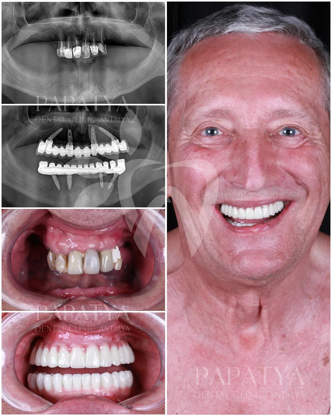 All-on-4-Implantate before and after result